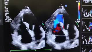 VENTRICULAR SEPTAL REPTUREVSR [upl. by Nospmis]