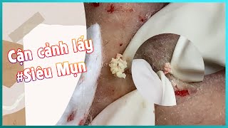 Big Cystic Acne Blackheads Extraction Blackheads amp Milia Whiteheads Removal Pimple Popping [upl. by Ibur]