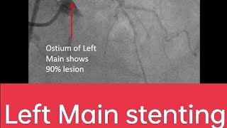 Left main PCI PTCA Stenting angiogram cardiology Intervention cardiology [upl. by Aihsena]