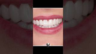 The Best Smile Design of 2024 with Cosmetic Veneers [upl. by Candie]