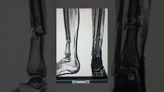 Tibia ap lateral view Fracture anatomy xraytechnician xray xrayinspection [upl. by Ayatnwahs]