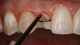 Direct Resin Bonded Bridge  Dental Online Training [upl. by Eldwun]