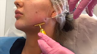 Jawline Filler London  by Dr Leah Totton [upl. by Ellenig]