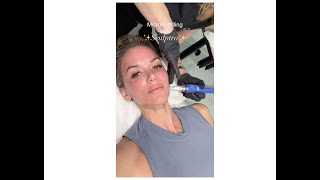 Boost your collagen Microneedling with Sculptra beauty collagen microneedling [upl. by Nena]