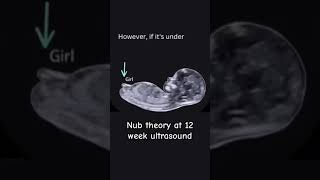 Guess the gender with Nub concept Gender ultrasound ultrasound genderultrasound [upl. by Nyrhtac305]