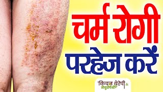 चर्म रोगी परहेज करें विरुद्ध आहार का सेवन न करें  Skin patients should not consume adverse foods [upl. by Drofla]