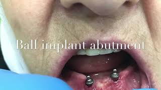 Implant overdenture [upl. by Shaikh]