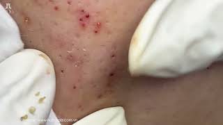 Big Cystic Acne Blackheads Extraction Blackheads amp Milia Whiteheads Removal Pimple Popping [upl. by Larimer579]