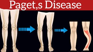 Paget’s Disease of Bone  Causes Pathogenesis Symptoms Diagnosis amp Treatment  Bone pagetdisease [upl. by Iggep]