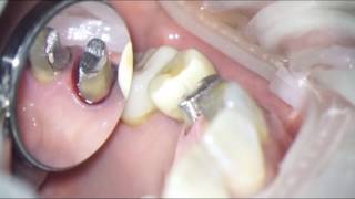 Subgingival prep technique [upl. by Sewel]