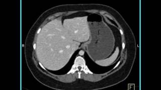 Abdomen Liver Focal Nodular Hyperplasia CT Angiography5 of 6 [upl. by Benita]