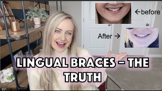 LINGUAL BRACES  My Experience with cost speech issues and traditional braces on lower teeth [upl. by Sucam658]