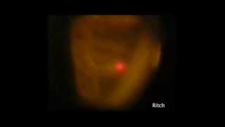 Argon Laser Peripheral Iridoplasty ALPI The BEST VIDEO Robert Ritch MD [upl. by Roxana]