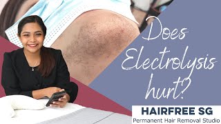 Does electrolysis hurt FAQs about electrolysis hair removal [upl. by Aynna]