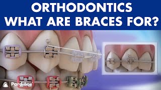 How Braces Work Elements of the orthodontic treatment and its role © [upl. by Asoj]