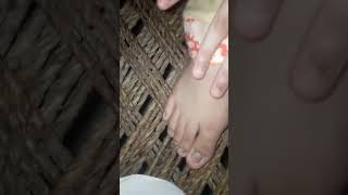 Trichophyton rubrum fungus nailinfection dermatology medical dermatology diagnosis foot [upl. by Dallas54]