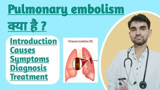 Pulmonary embolism in Hindi  Causes  Sign and Symptoms  Treatment of Pulmonary Embolism [upl. by Baal360]