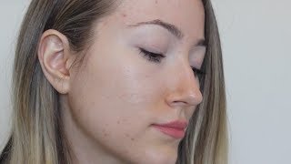 THE TRUTH WHY ACCUTANE DIDNT WORK [upl. by Hola]