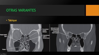 Anatomía y patología de los senos paranasales Dr Franklin O Ordoñez [upl. by Tiffany958]