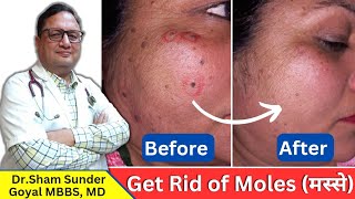 Mole मस्से Removal Procedure  Get Rid of Moles [upl. by Adalai]