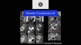 MRI of the Hip Part 3 – Hip Trauma [upl. by Boothman]