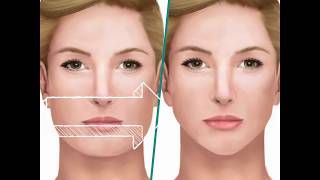 Reducción Ángulos Mandibulares Cirugía Mandíbula Reducción facial [upl. by Atsyrc]