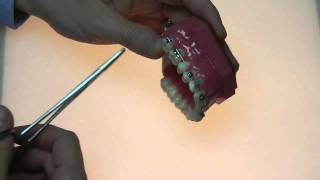 Common orthodontic emergencies Loose wire [upl. by Haland]