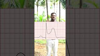 Ecg diagnosis of MI ytshorts shortfeed shortvideo [upl. by Belmonte]