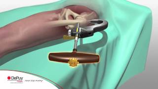 DePuycom AFFIXUS® Hip Fracture Nail [upl. by Remle]