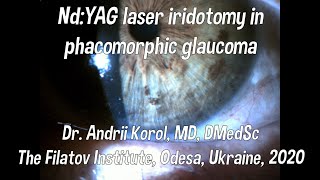 NdYAG laser iridotomy in phacomorphic glaucoma [upl. by Cigam790]