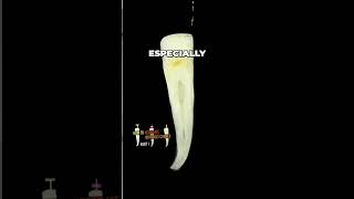 Mastering Root Canal Shaping Overcoming Apex Challenges [upl. by Nic392]