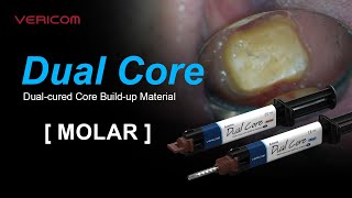 Dual Cured Core Build up Material Molar [upl. by Eecart496]