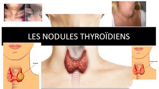 nodule thyroïdienne  part 1 [upl. by Yran]