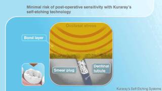 Kuraray Selfetch demonstration  dental use [upl. by Eille]