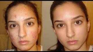 A true miracle How I got rid of my acne Daily skincare routine [upl. by Aldora585]