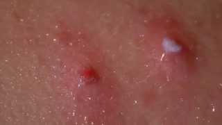 Peroxide Sprayed On Popped Back Pimples  After The Pop Zit [upl. by Tuorah278]