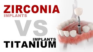 Zirconia Implants VS Titanium Implants  Aria Dental  Maryam Horiyat DDS [upl. by Plume154]