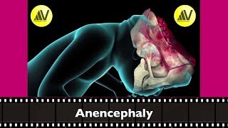 Anencephaly Explained [upl. by Ahern]