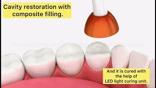 ✨Class l cavity restorationwith composite filling✨ drdhruvaodccshorts9385 dentalcare [upl. by Kutzer716]