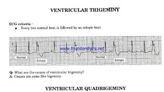 Ventricular Bigeminy Trigeminy amp Quadrigeminy [upl. by Yetta]