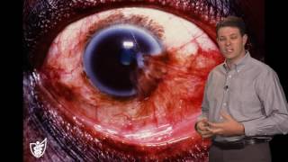 PANCE amp PANRE Review Course Sample Video  Eye Disorders Part 1 [upl. by Catima]