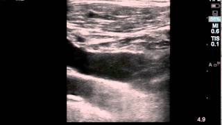 Ultrasound Guided Subclavian Vein Cannulation [upl. by Lertnahs]