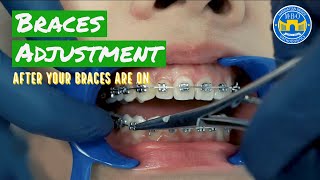 How Do Braces Straighten Teeth [upl. by Cassandra476]