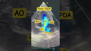 PDA Patent Ductus Arteriosus Pediatric Echo ♥️ [upl. by Hindu]