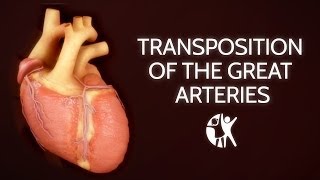 Transposition of the Great Arteries [upl. by Mctyre764]