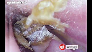 Ear Wax Removal 106 His Ears Are Very Itchy Because Of Fungal Earwax  Ear Cleaning ASMR [upl. by Dettmer]