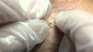 Releasing an Ingrown Hair [upl. by Hound208]