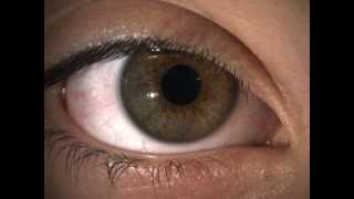 Hippus pupil fluctuation in a normal healthy eye [upl. by Foscalina]