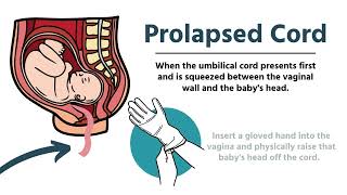 Pregnancy amp Delivery Emergencies in EMS [upl. by Whitcomb841]