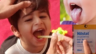 Treat Oral Thrush At Home [upl. by Lalitta806]